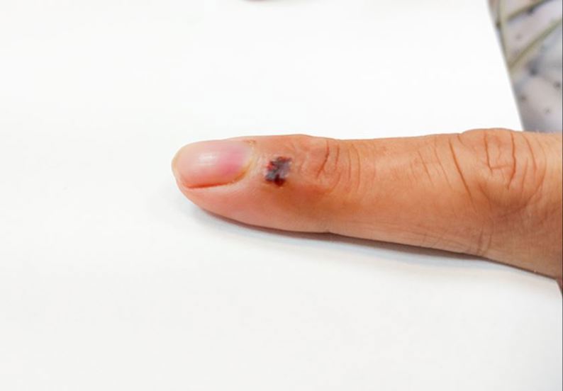 Mèo cắn có sao không? Cách xử lý khi bị mèo cắn